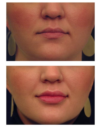 Restylane before 82765