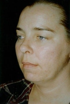 Facelift / Neck Lift before 360838