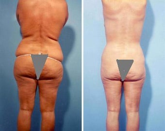 Liposuction before 636265