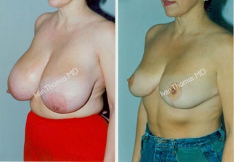 Breast Reduction before 243743