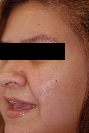 Laser Resurfacing after 89110