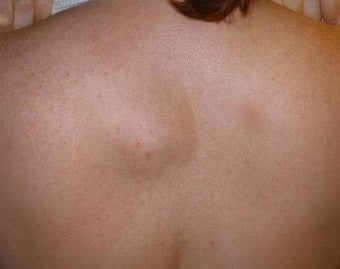 Back lipoma removal before 156828