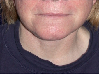 Necklift after 208458