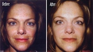 Microderm full face Before and After before 6395