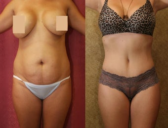 tummy tuck 637904