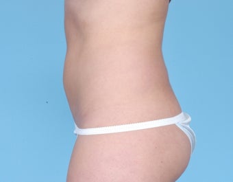 CoolSculpting 506622