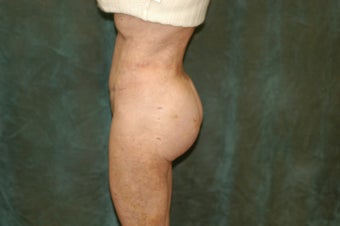 Women's Buttocks Augmentation after 518120