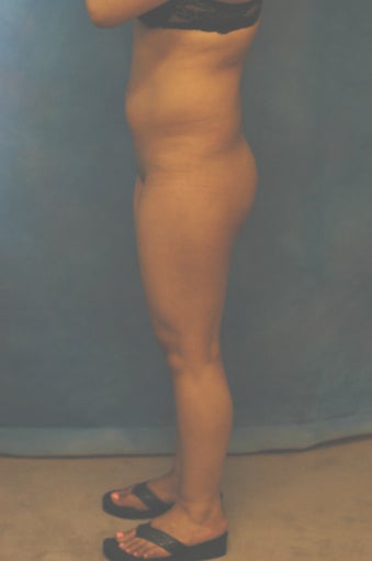 Women's Buttocks Augmentation before 518130