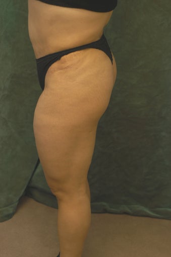 Women's Buttocks Augmentation before 518138