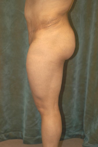 Women's Buttocks Augmentation after 518138