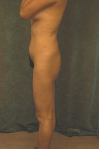 Women's Buttocks Augmentation before 518149