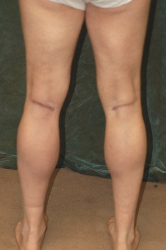Men's Calf Augmentation after 519057