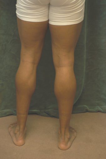 Men's Calf Augmentation before 519058