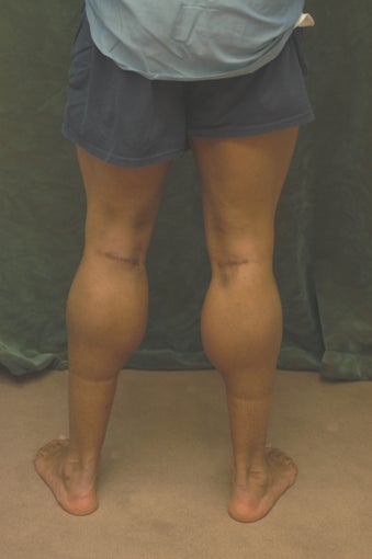 Men's Calf Augmentation after 519058