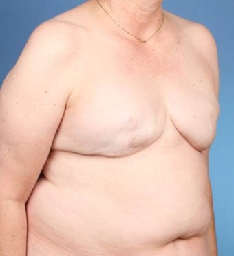 Breast Reconstruction 519678