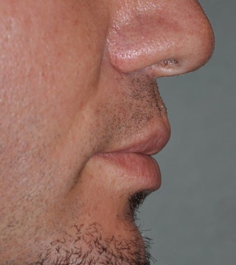 Lip Lift 521702