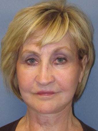 Lite Lift™, Eyelid lift, brow lift, Liposuction to chin 523310