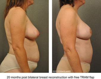 Breast Reconstruction 529310