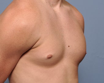 Pectoral Implants 536031