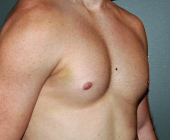 Pectoral Implants 536031