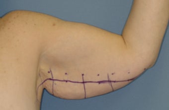 Arm Lift 536869
