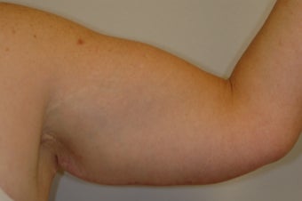 Arm Lift 536869