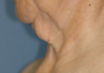 Neck Lift 537410