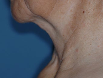 Neck Lift 537410