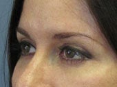 Brow Lift 541476