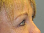 Brow Lift 541495