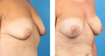 Breast Reconstruction: One-Stage Breast Reconstruction 561811
