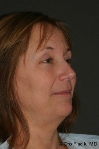Neck Lift 567427