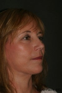 Neck Lift 567427