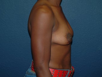 Breast Augmentation 575278