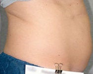 Liposonix 582693