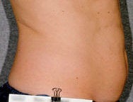 Liposonix 582693