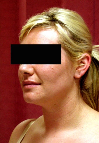 liposuction of neck & jaw line for women 583584