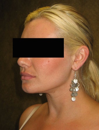 liposuction of neck & jaw line for women 583584