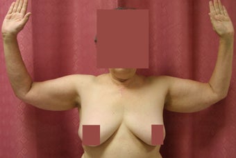 Brachioplasty or arm tuck in los angeles 583674