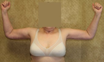 Brachioplasty or arm tuck in los angeles 583674