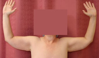 Brachioplasty or arm tuck 583684