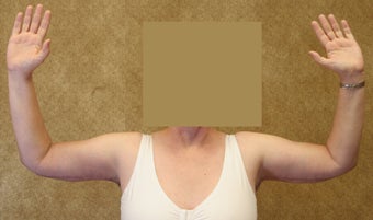 Brachioplasty or arm tuck 583684