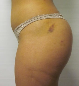 Brazilian Butt Lift 588362