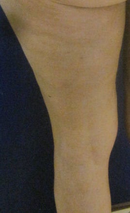 Cellulaze after 593042