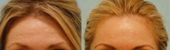Botox before 138510