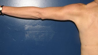 Brachioplasty 576423
