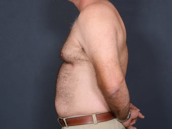 Liposuction 640754