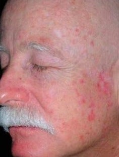 PDT for rosacea before 376140