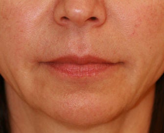 Anguloplasty after 299919