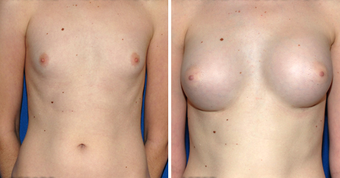 Breast Implants before 494493